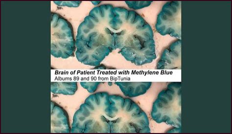 Methylene Blue Brain Autopsy: New Clues in Alzheimer's Research?